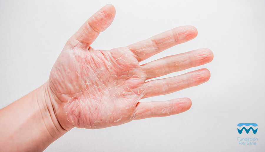 manos eczema dermatologia Tenerife dermocosmetica consejos